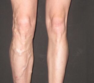La varicosis se desarrolla rápidamente