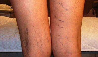 Síntomas de venas varicosas en mujeres