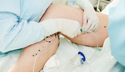 Métodos para tratar las venas varicosas en mujeres en mujeres