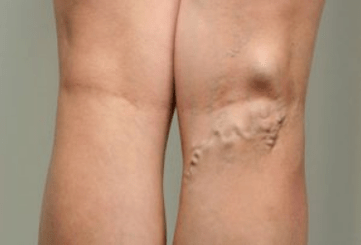 Diagnóstico de varices en mujeres embarazadas.