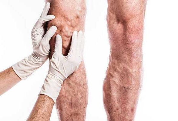 Palpación de varices en las piernas.